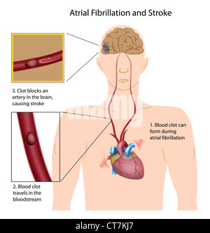 Atrial fibrillation and stroke Stock Photo