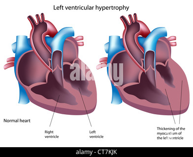 Left ventricular hypertrophy Stock Photo