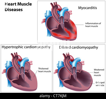 Diseases of heart muscle Stock Photo