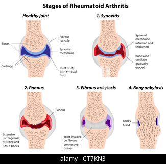 Stages of rheumatoid arthritis Stock Photo