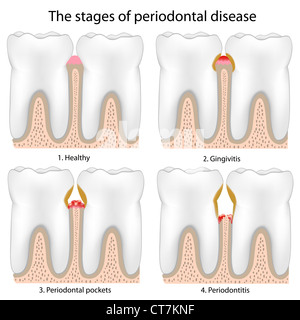 Periodontal Disease Stock Photo