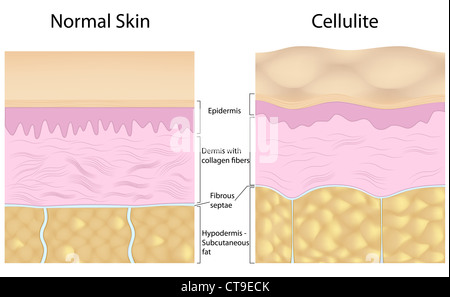 Cellulite versus smooth skin Stock Photo