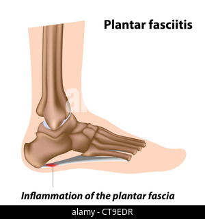 Plantar Fasciitis. Illustration human foot anatomy explain on symptom ...