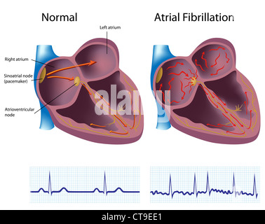 Atrial fibrillation Stock Photo