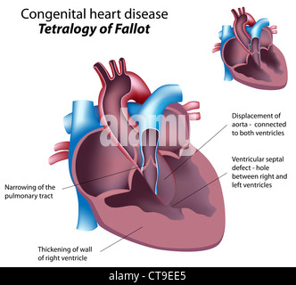 Congenital heart disease: Tetralogy of Fallot Stock Photo