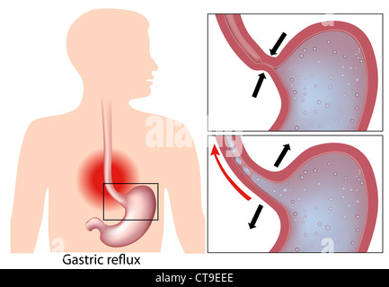 Heartburn (stomach acid reflux) mechanism Stock Photo