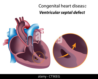 Congenital heart disease: ventricular septal defect Stock Photo