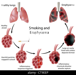 Alveoli and Lung diseases Stock Photo - Alamy