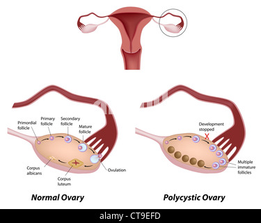Normal ovary and Polycystic ovary syndrome Stock Photo