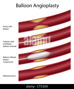 Coronary Artery Stenosis with Angioplasty Stock Photo ...