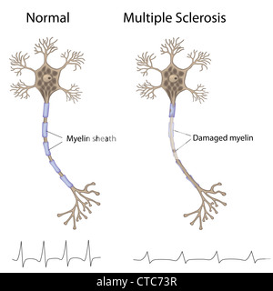 Multiple sclerosis Stock Photo