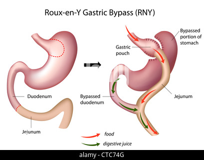 Roux-en-Y Gastric Bypass (RNY) surgery Stock Photo