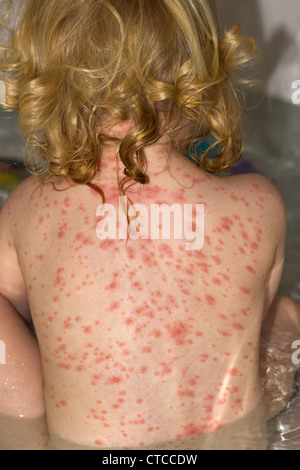 Girl with chicken pox spots on her back Stock Photo