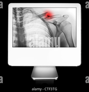 Arm fracture appearing on diagnostic monitor Stock Photo
