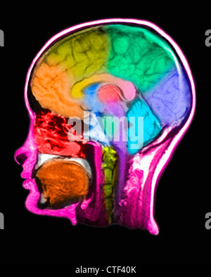 MRI scan of a human brain Stock Photo - Alamy