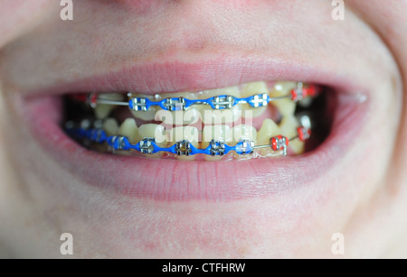 Teenage kids mouth close up teeth lips braces boy 13 14 mouthes Stock Photo