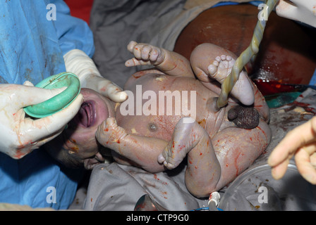 Infant delivered by Caesarean section. Stock Photo