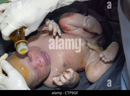 Infant delivered by Caesarean section. Stock Photo