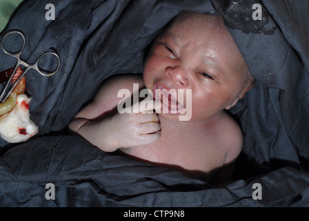 Infant delivered by Caesarean section. Stock Photo