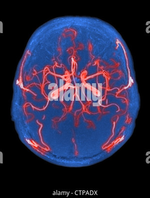 Normal arterial blood supply to the brain Stock Photo