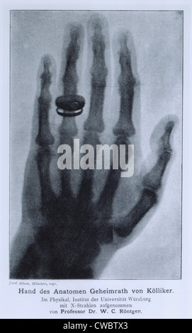 Konrad Roentgen's X-ray of the hand of Professor Albert von Kolliker, showing bones and the ring he was wearing. The x-ray was Stock Photo