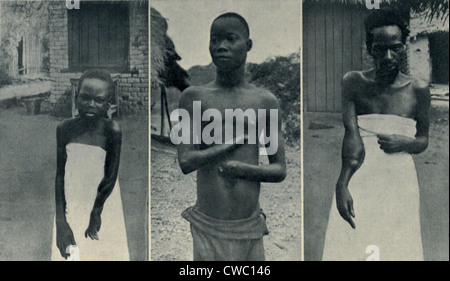 Atrocities of the Rubber Slavery in the Belgian Congo. Mongala (left) and Biasia (right) arms were shattered by gunshots of Stock Photo