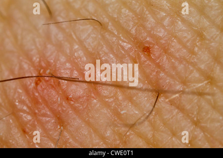 Scabies infected skin, close-up.