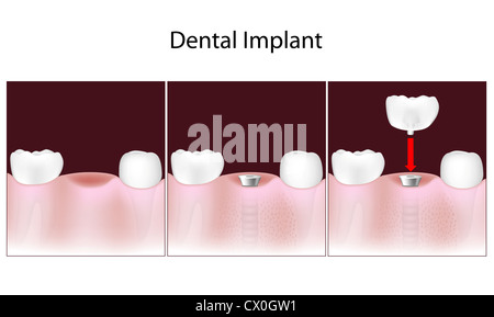 Dental implant procedure Stock Photo