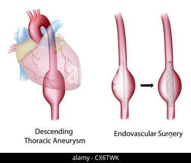 Thoracic (descending) aortic aneurysm and endovascular surgery Stock Photo
