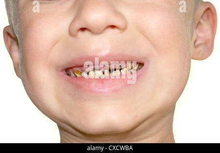 Calf's Teeth decay Toothache because of too many sugar in food Dental Medicine Stock Photo
