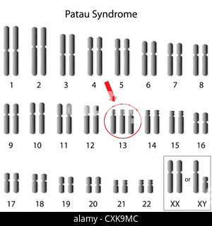 Patau Syndrome Karyotype Trisomy Stock Photo Alamy