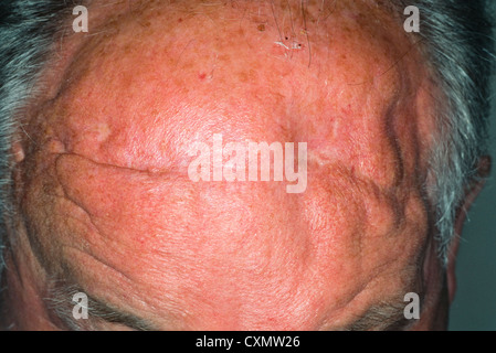 Craniotomy scar Stock Photo  Alamy