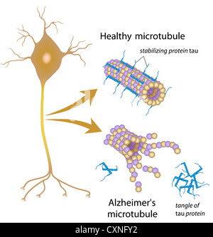 Disintegrating microtubules in Alzheimer's disease Stock Photo