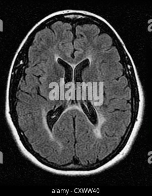 MRI of multiple sclerosis in a 42 year old woman Stock Photo