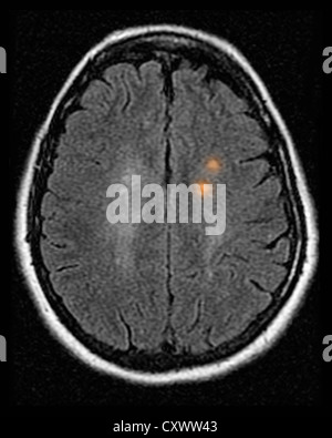 MRI of multiple sclerosis in a 42 year old woman Stock Photo