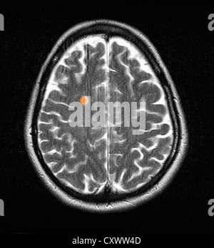 MRI of multiple sclerosis in a 42 year old woman Stock Photo