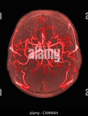 Normal arterial blood supply to the brain Stock Photo