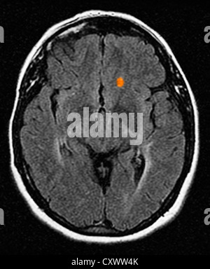 MRI of multiple sclerosis in a 42 year old woman Stock Photo