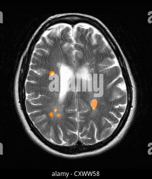 MRI of multiple sclerosis in a 42 year old woman Stock Photo