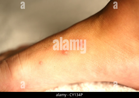 Bed bug bites on a man's foot Stock Photo - Alamy