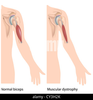 Muscular dystrophy Stock Photo