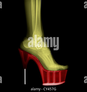 Coloured X-ray of a woman leg wearing Stiletto High-Heeled Shoe Stock Photo
