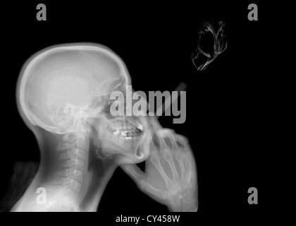 X-ray of a man smoking a cigarette Stock Photo