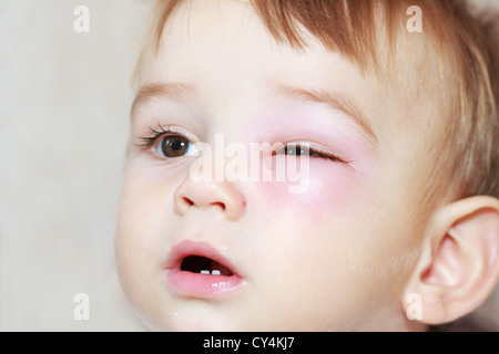 little boy - dangerous stings from wasps near the eye Stock Photo