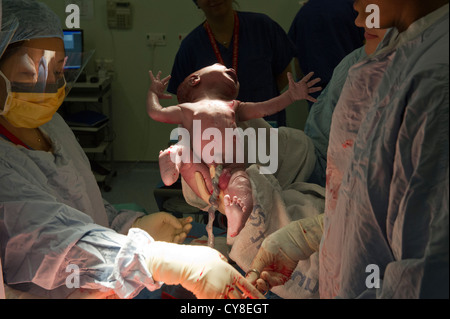 A baby boy being born by Cesarean  section by operating staff from Kings College Hospital, South London Stock Photo