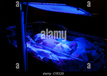 Newborn baby with neonatal jaundice and high bilirubin hyperbilirubinemia under blue UV light for phototheraphy. Stock Photo