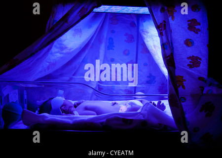 Newborn baby with neonatal jaundice and high bilirubin hyperbilirubinemia under blue UV light for phototheraphy. Stock Photo