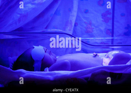 Newborn baby with neonatal jaundice and high bilirubin hyperbilirubinemia under blue UV light for phototheraphy. Stock Photo