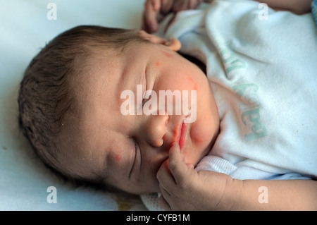 eritema tóxico neonatal