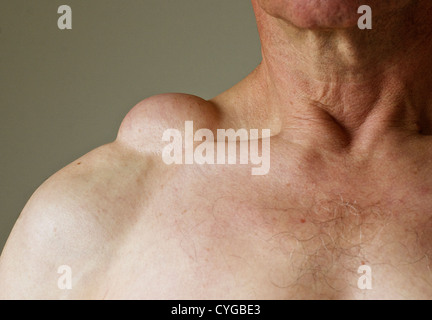 lipoma shoulder fatty benign tumour male alamy